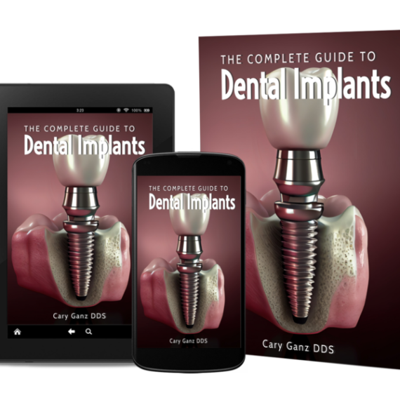 Total Guide to Dental Implants