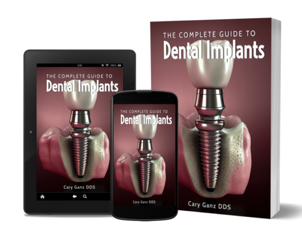 Total Guide to Dental Implants