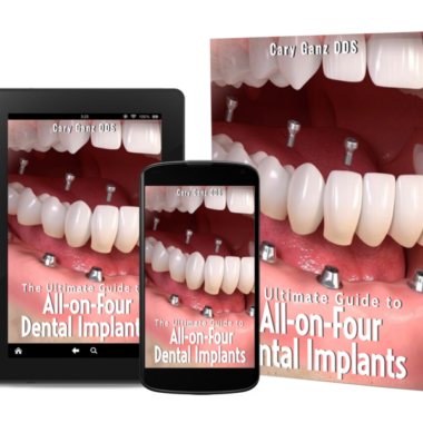 The Ultimate Guide to All-on-Four Dental Implants- Over 80 Pages