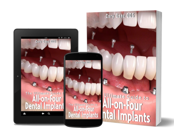 The Ultimate Guide to All-on-Four Dental Implants- Over 80 Pages